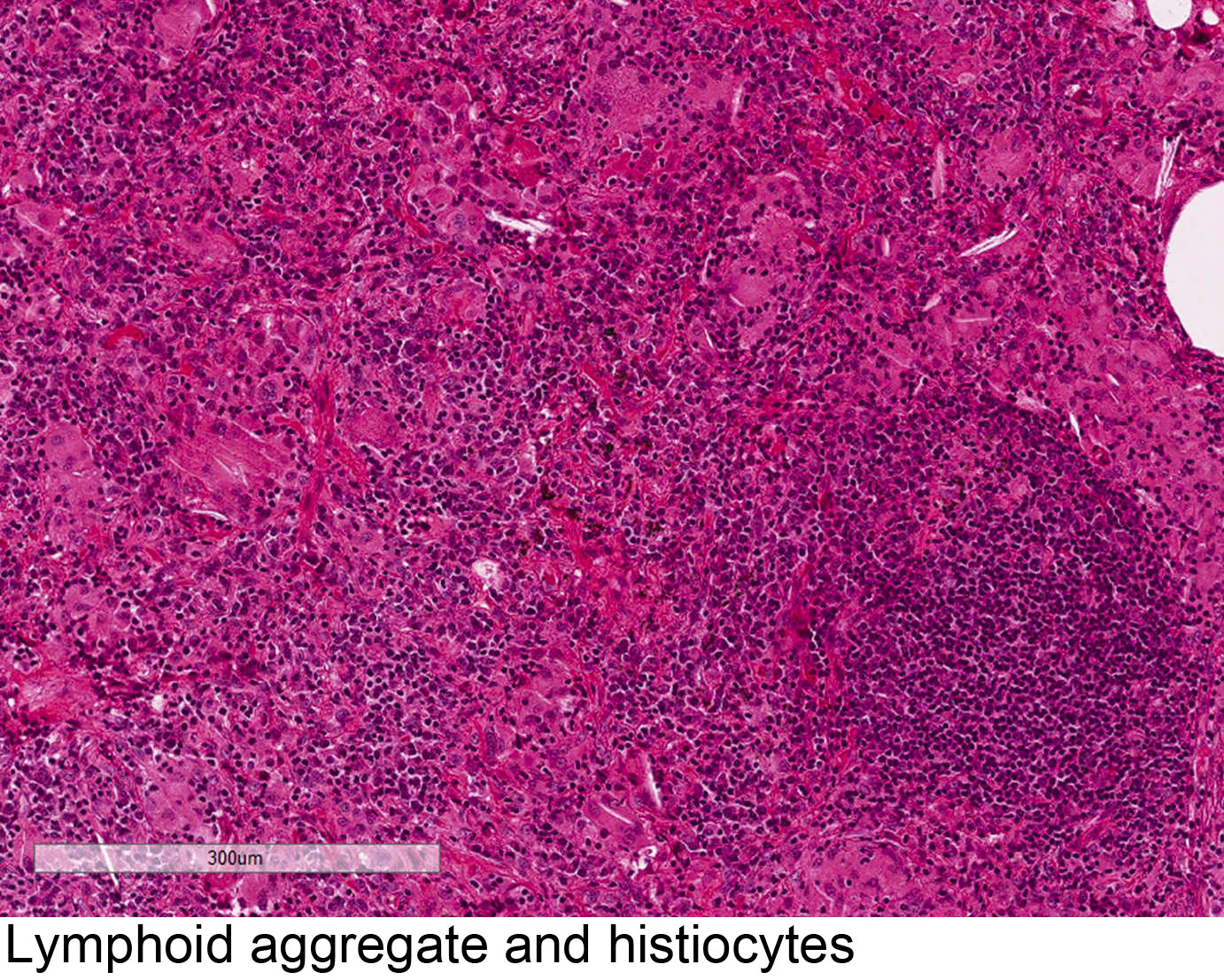 Lymphoid aggregate and histiocytes