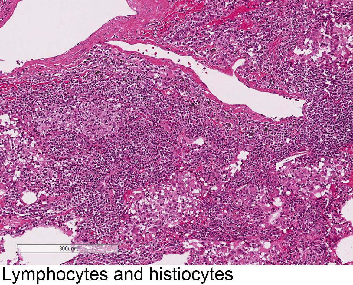 Lymphocytes and histiocytes
