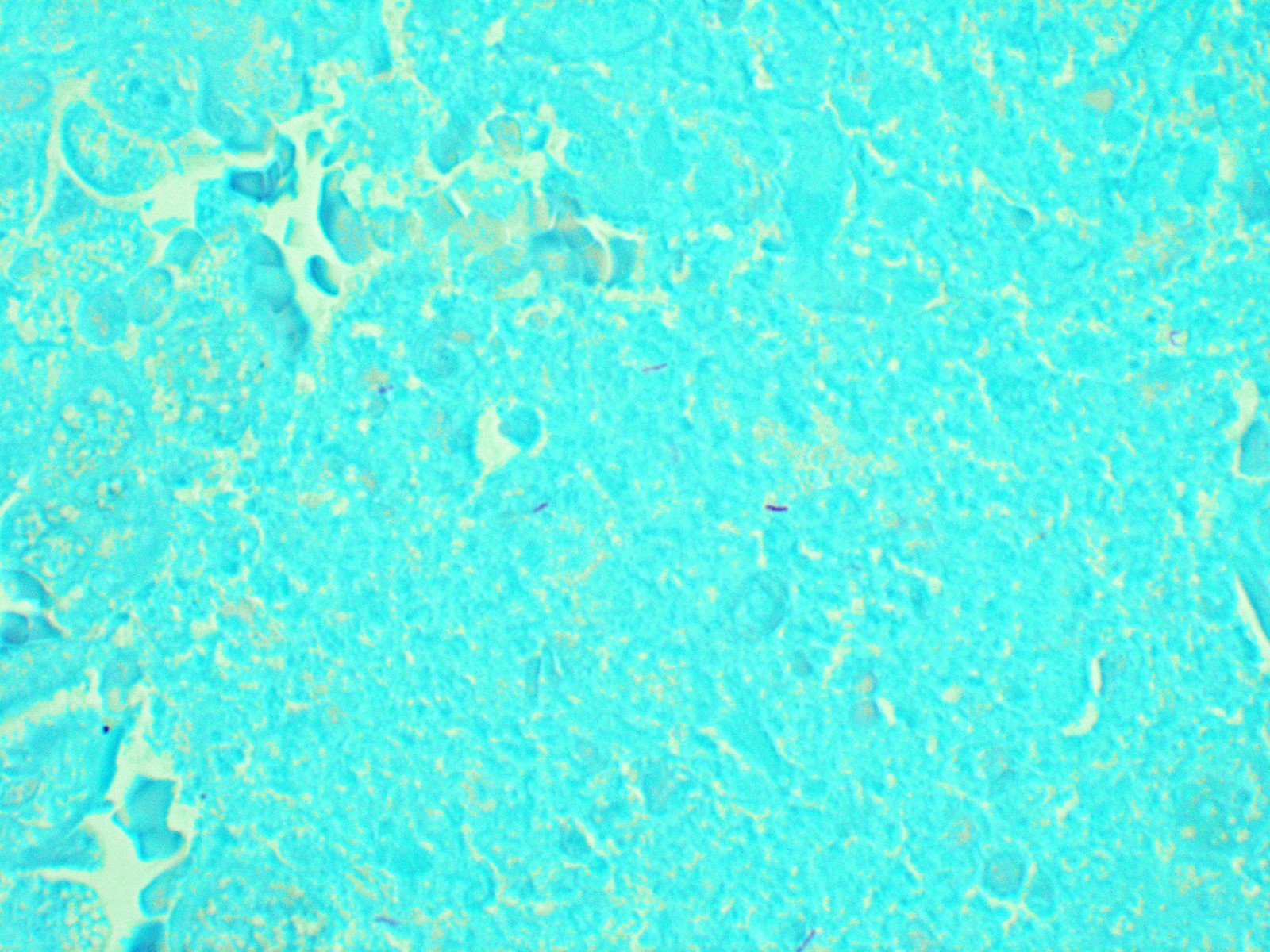 Positive AFB stain