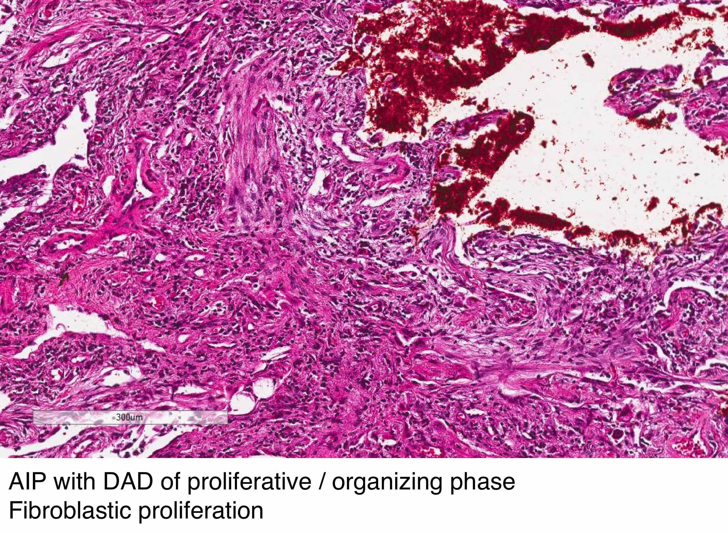Fibroblastic proliferation