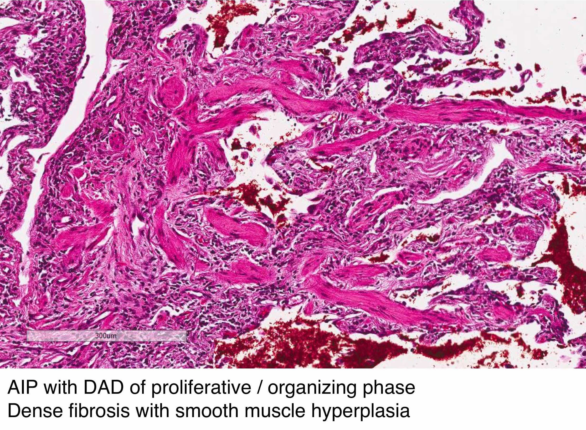 Dense fibrosis with smooth muscle hyperplasia