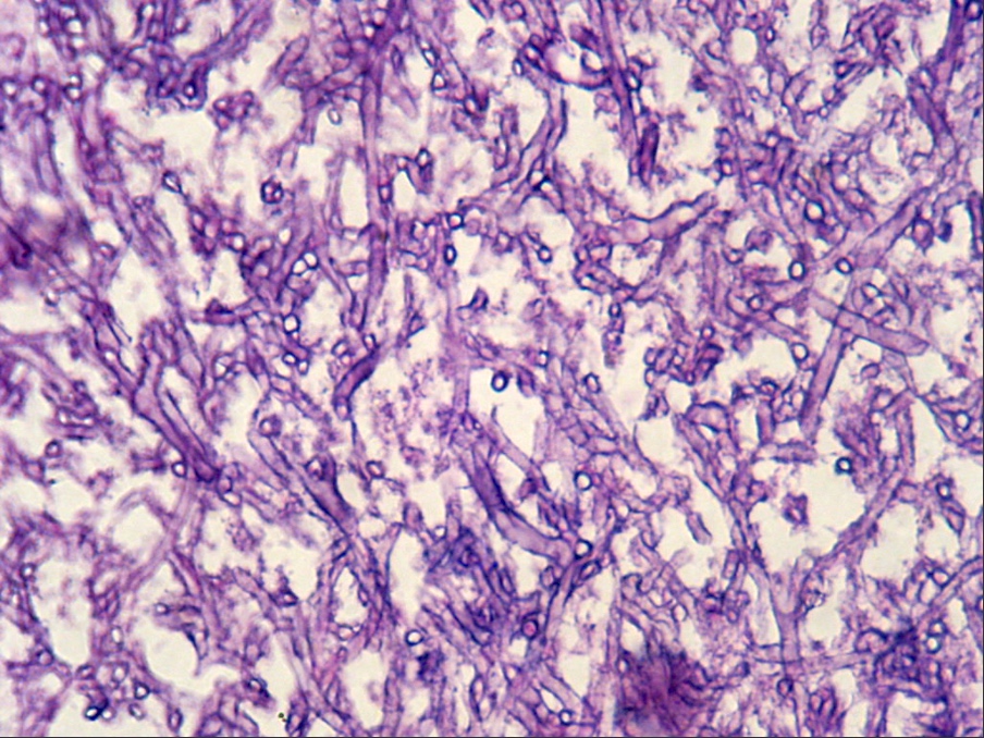 Fungal hyphae, PAS stain