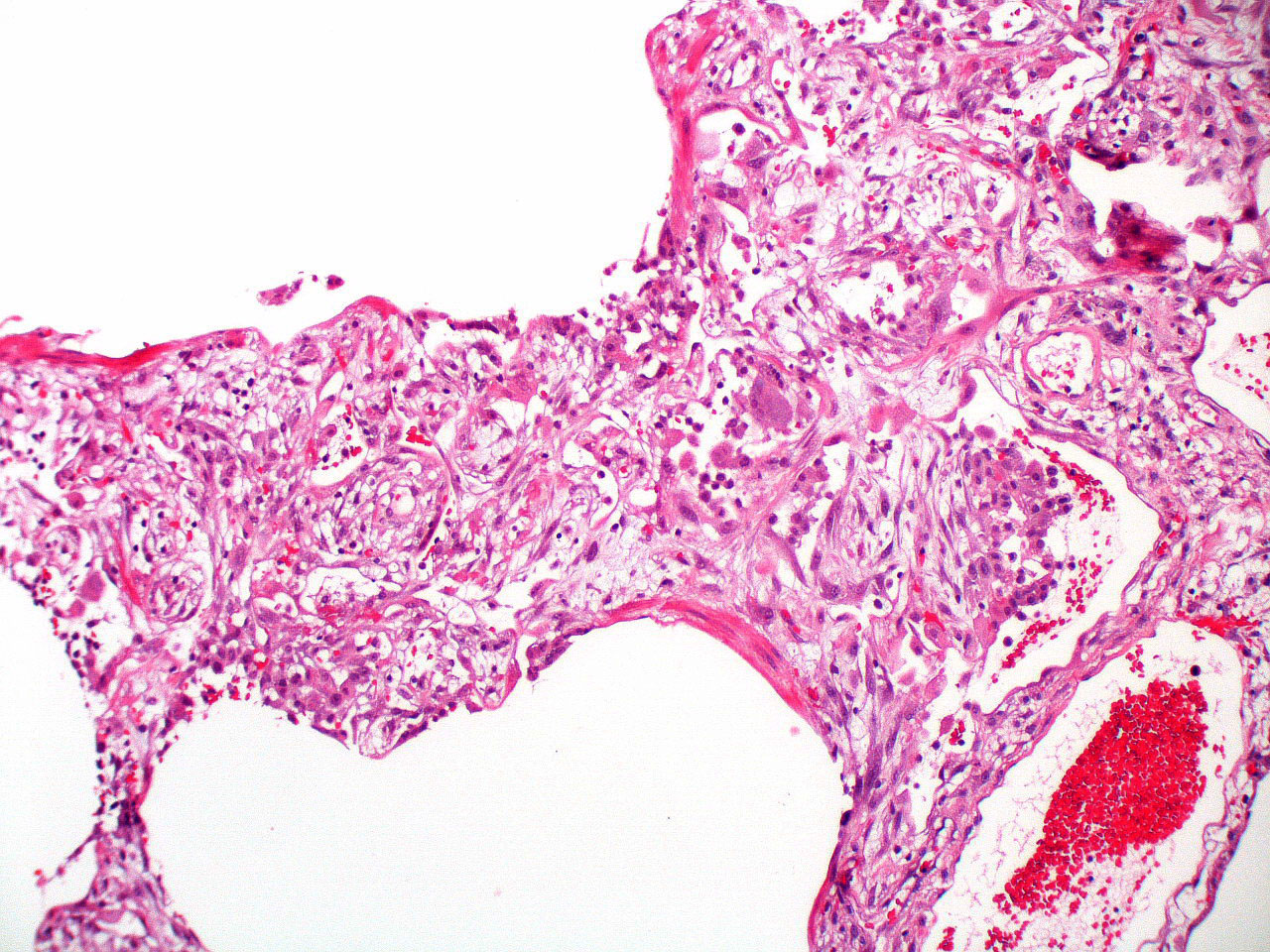 Fibroblastic proliferation