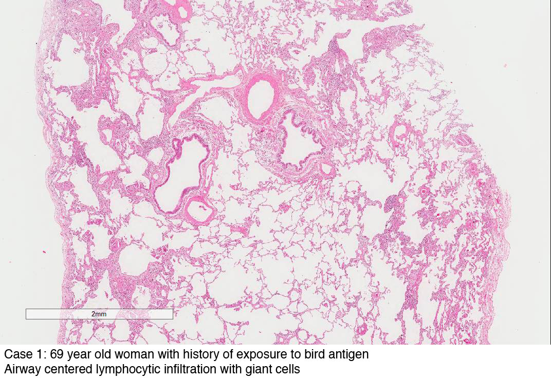 Case 1: 69 year old woman with history of exposure to bird antigen
