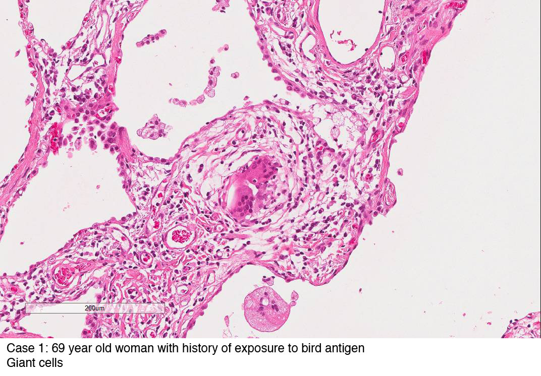 Case 1: 69 year old woman with history of exposure to bird antigen