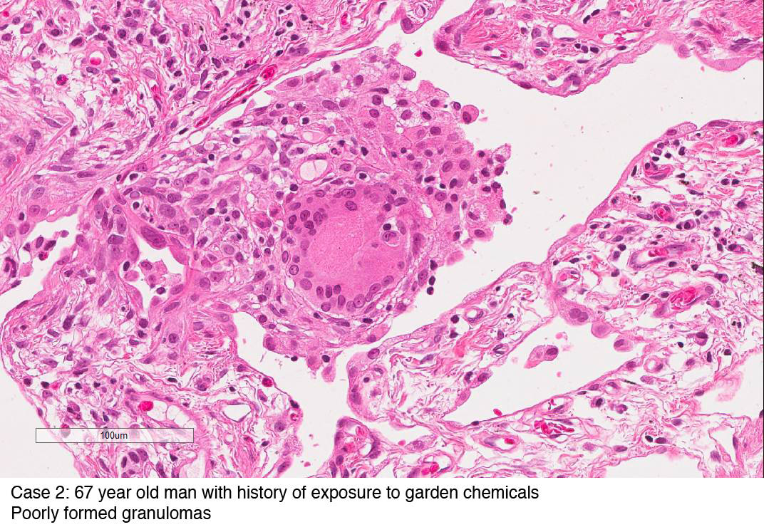 Case 2: 67 year old man with history of exposure to garden chemicals