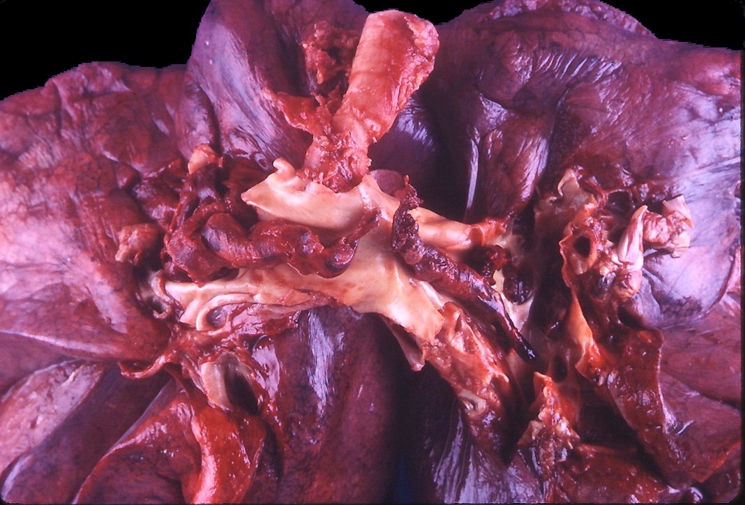 Infarct / pulmonary emboli