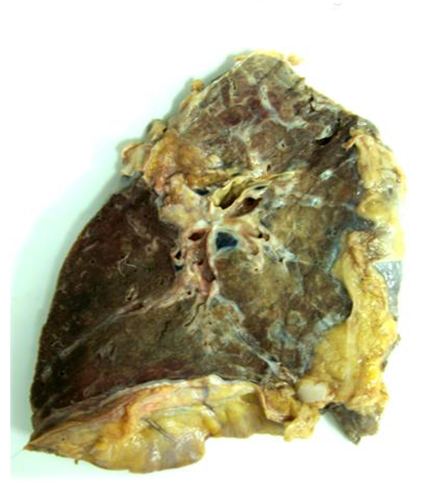 Chronic lung allograft dysfunction