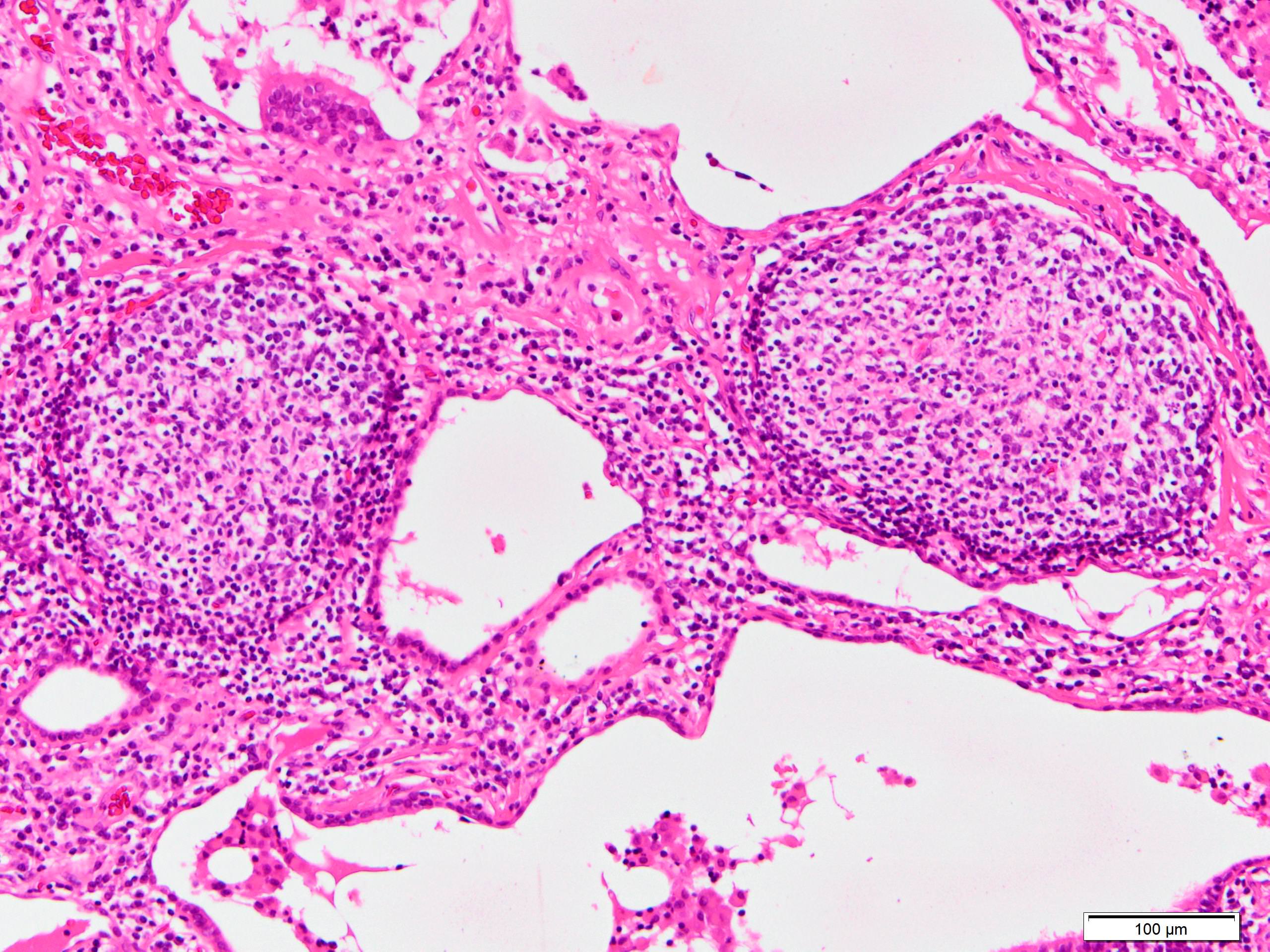 Lymphoid follicles with germinal center