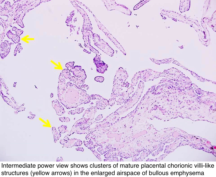 Clusters of mature placental chorionic villi-like structures