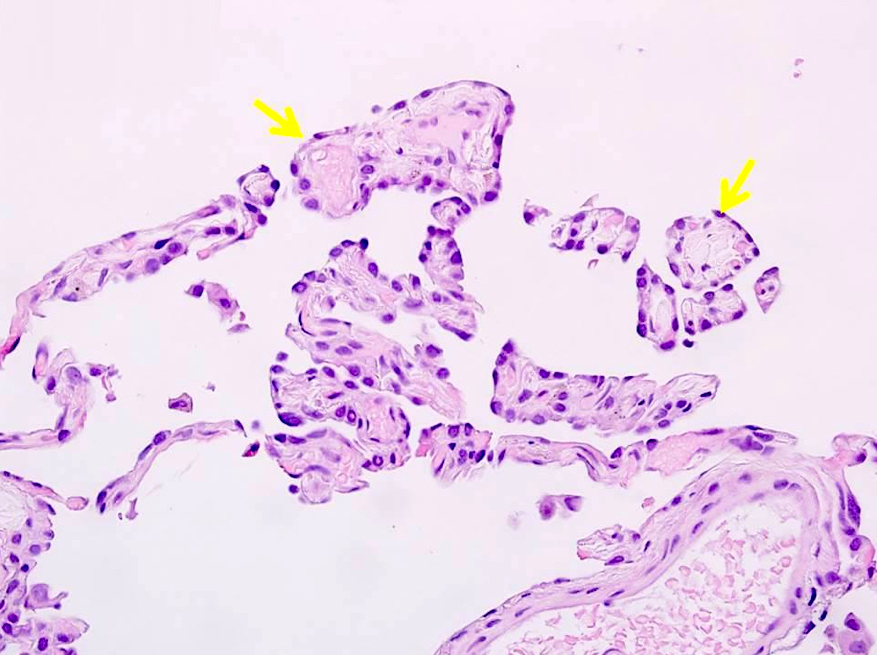 Clusters of mature placental chorionic villi-like structures
