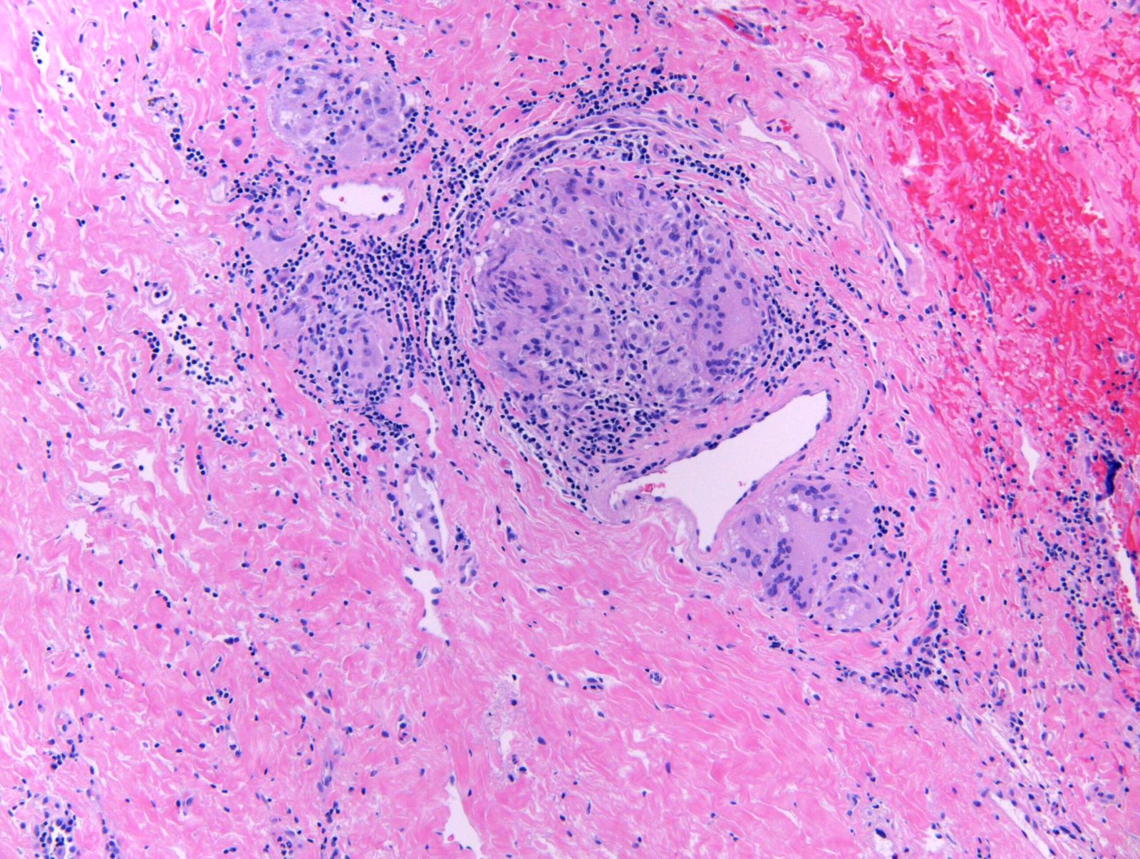 Multinulceated giant cells and fibrosis