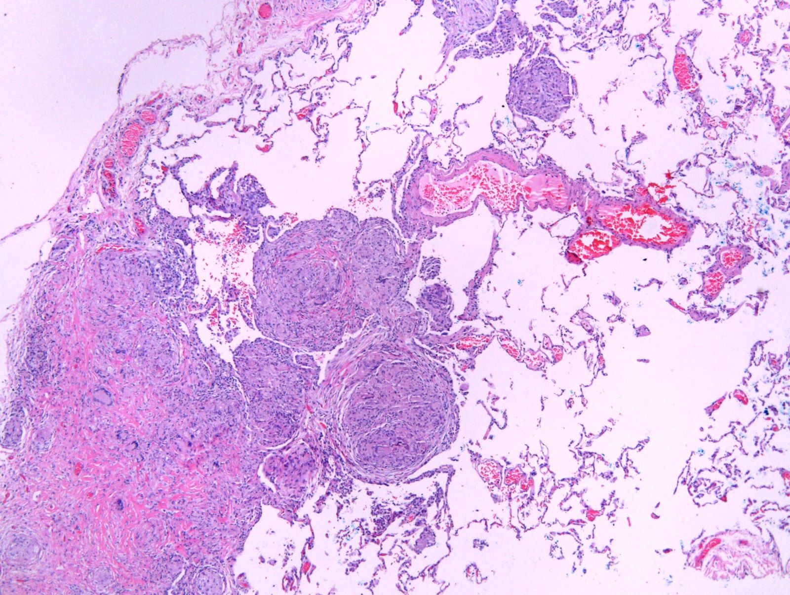 Granulomas of bronchovascular bundle and pleura
