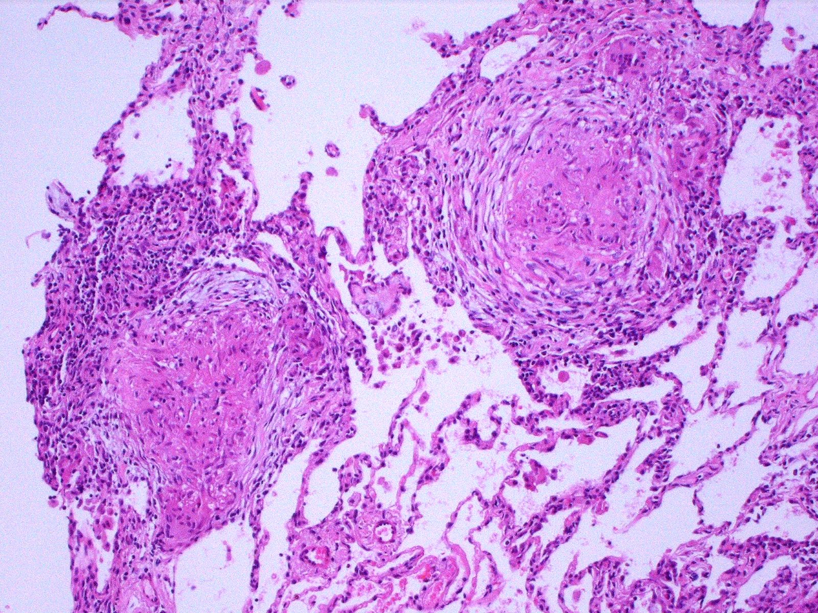 Sarcoidosis histology