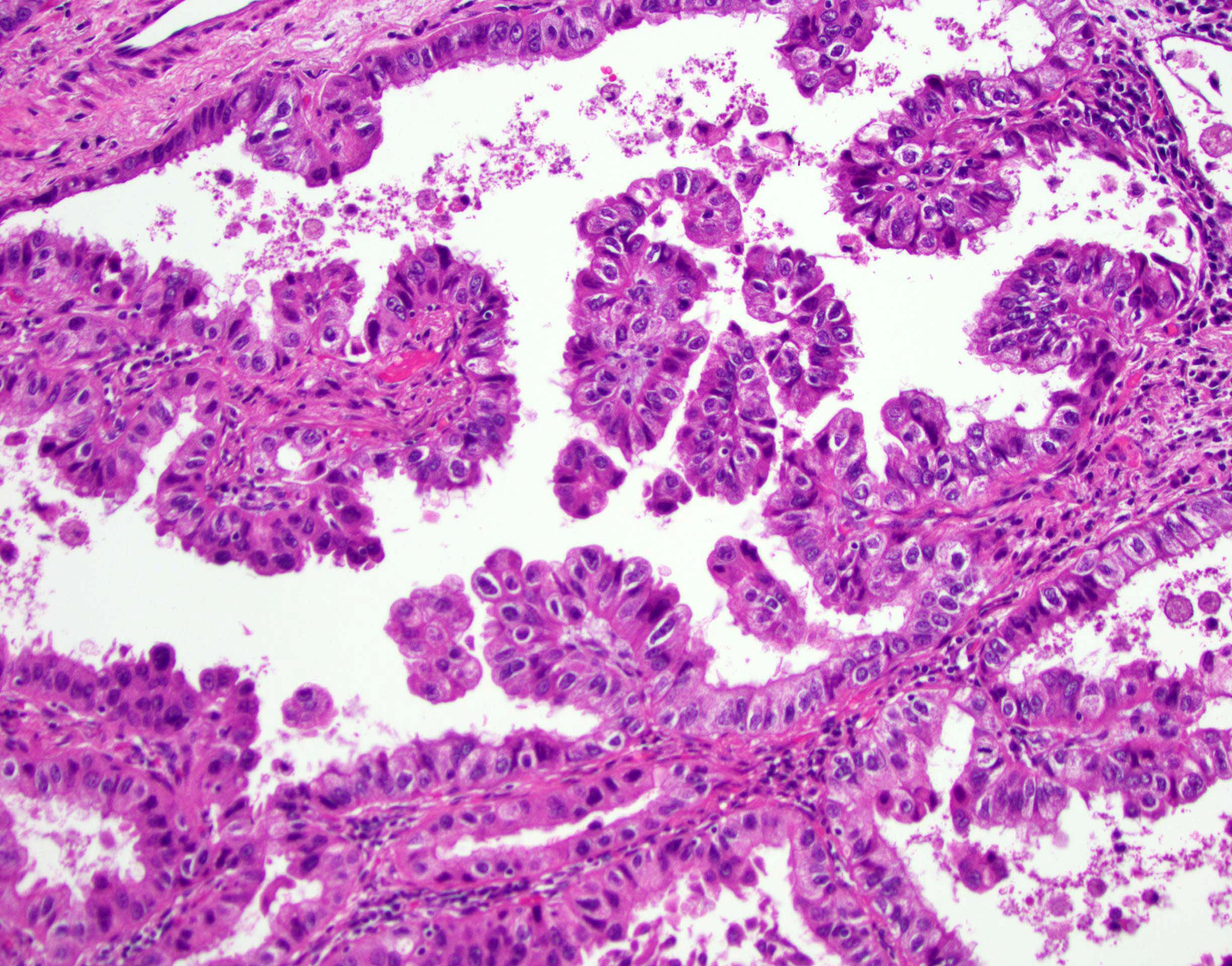 Papillary lesion lung - Papillary thyroid cancer lung nodule