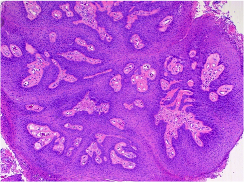 Squamous cell papilloma skin pathology outlines, Papilloma skin pathology outline