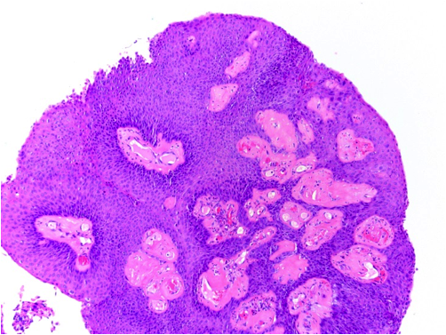 Squamous papilloma skin pathology outlines, Papilloma of skin histology. Archive issue | RJME