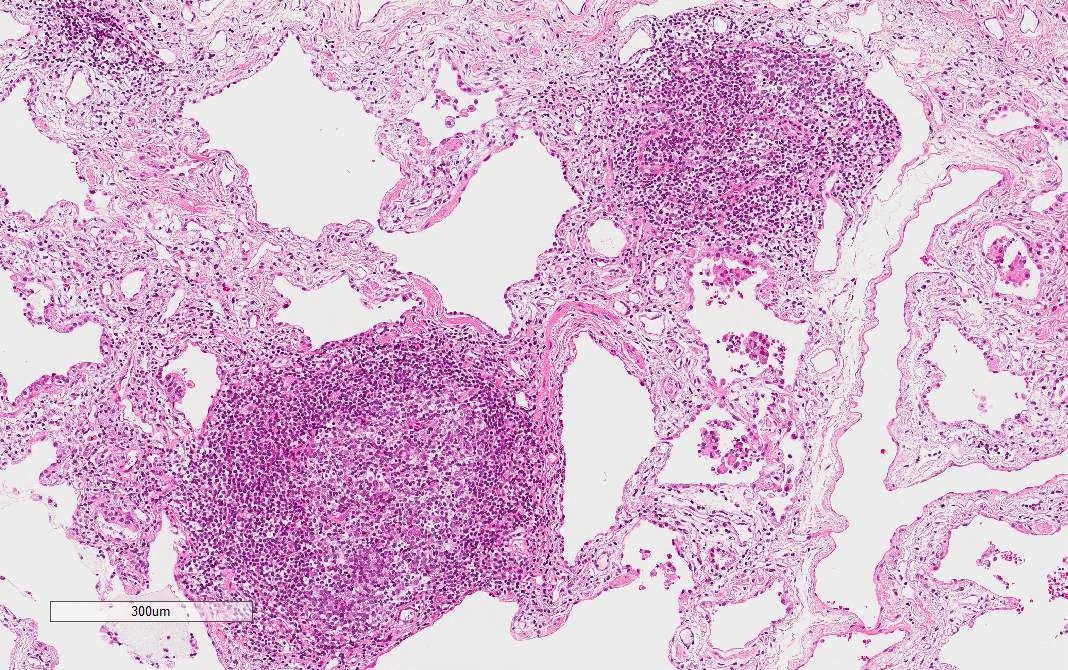 Lymphoid follicles with germinal centers