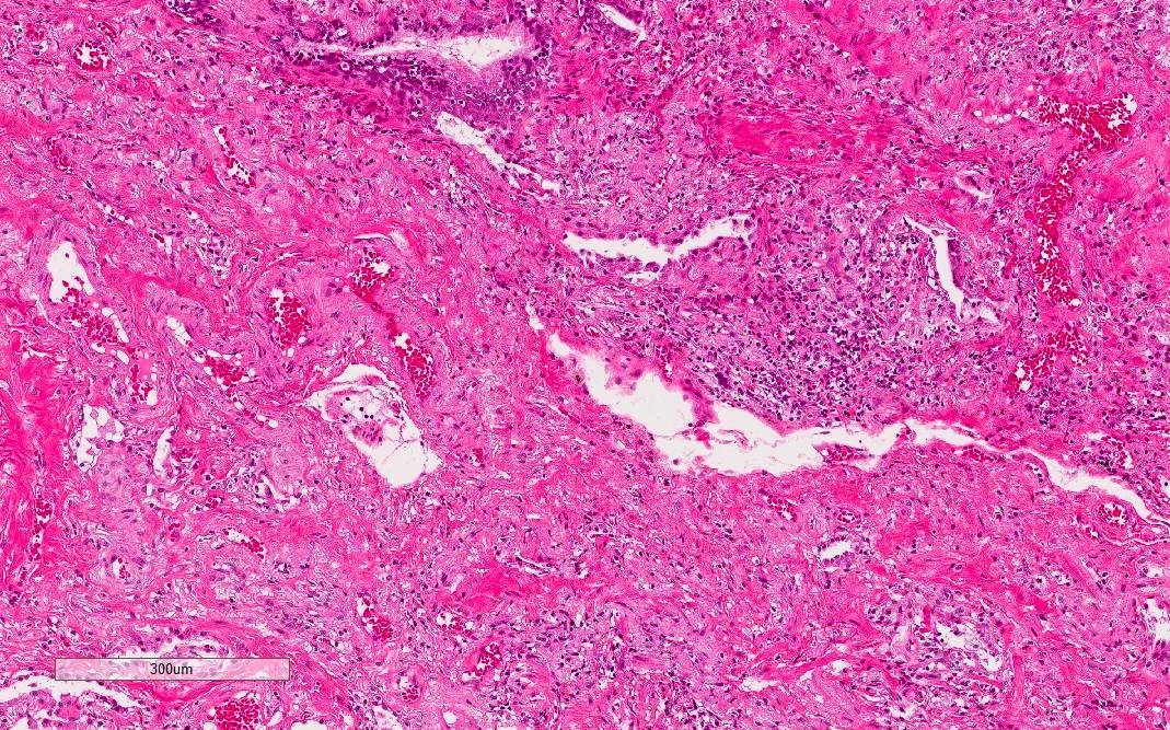 Dense fibrosis with lymphocytic infiltration