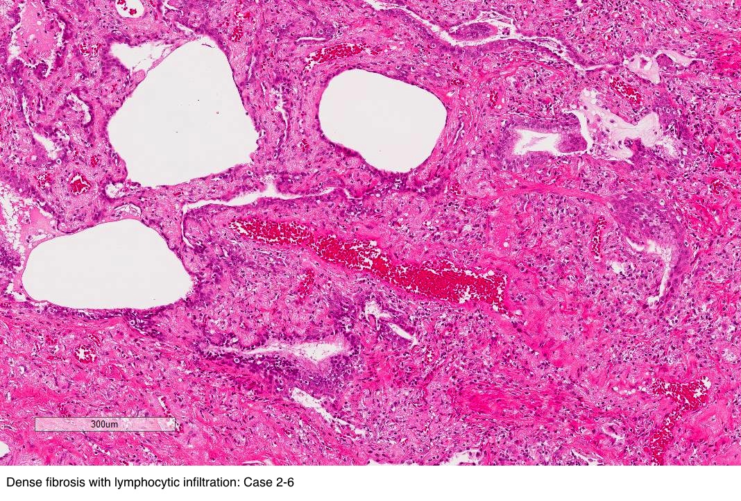 Dense fibrosis with lymphocytic infiltration