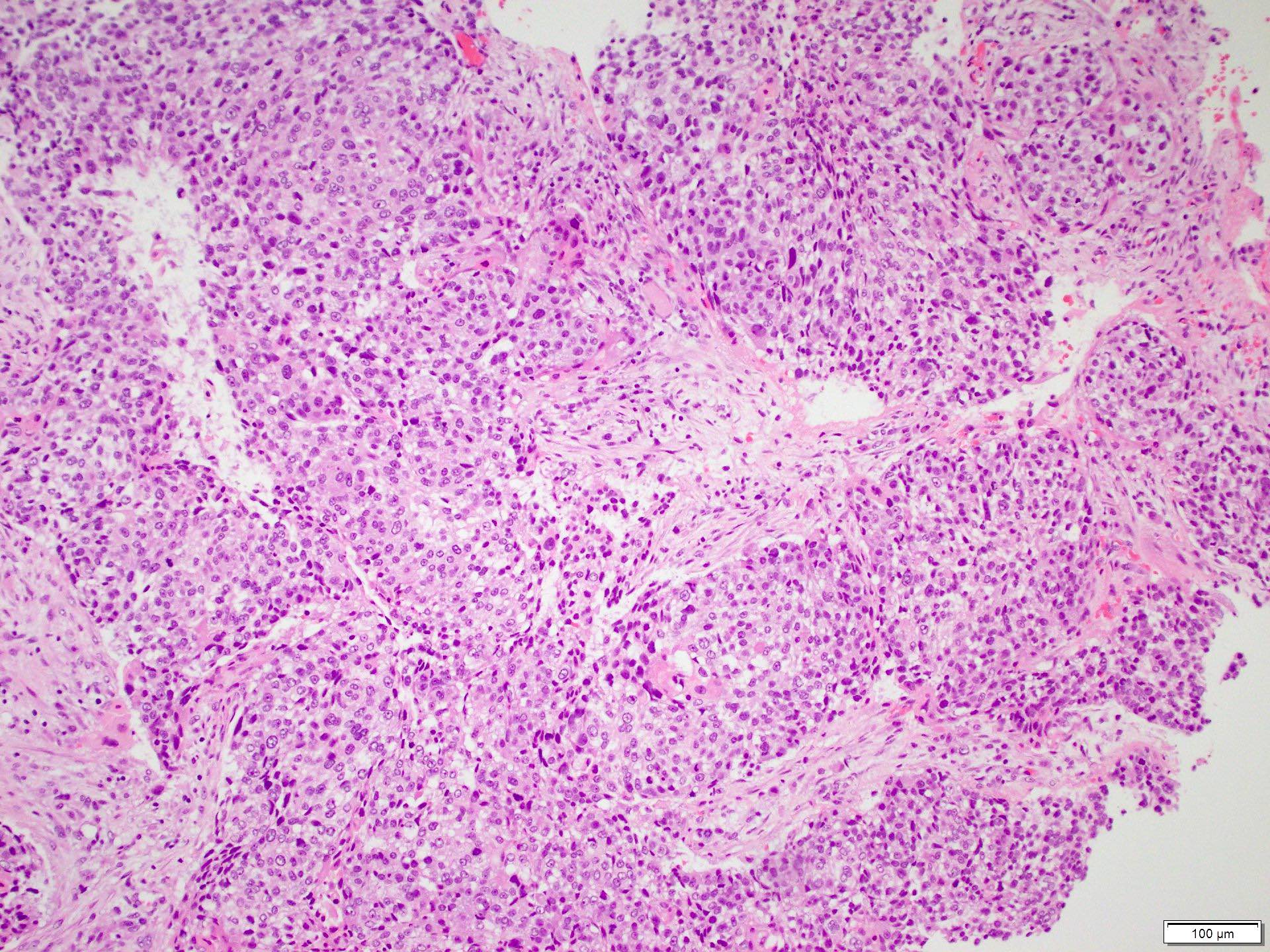Nonkeratinizing, moderately differentiated squamous cell carcinoma