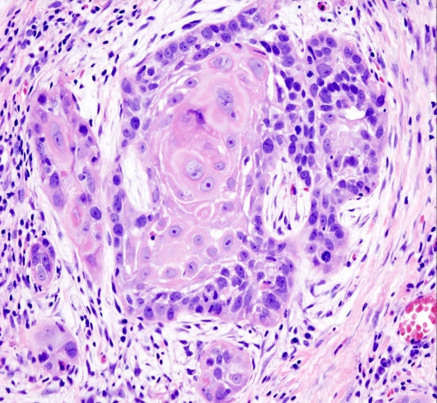 Well differentiated squamous cell carcinoma