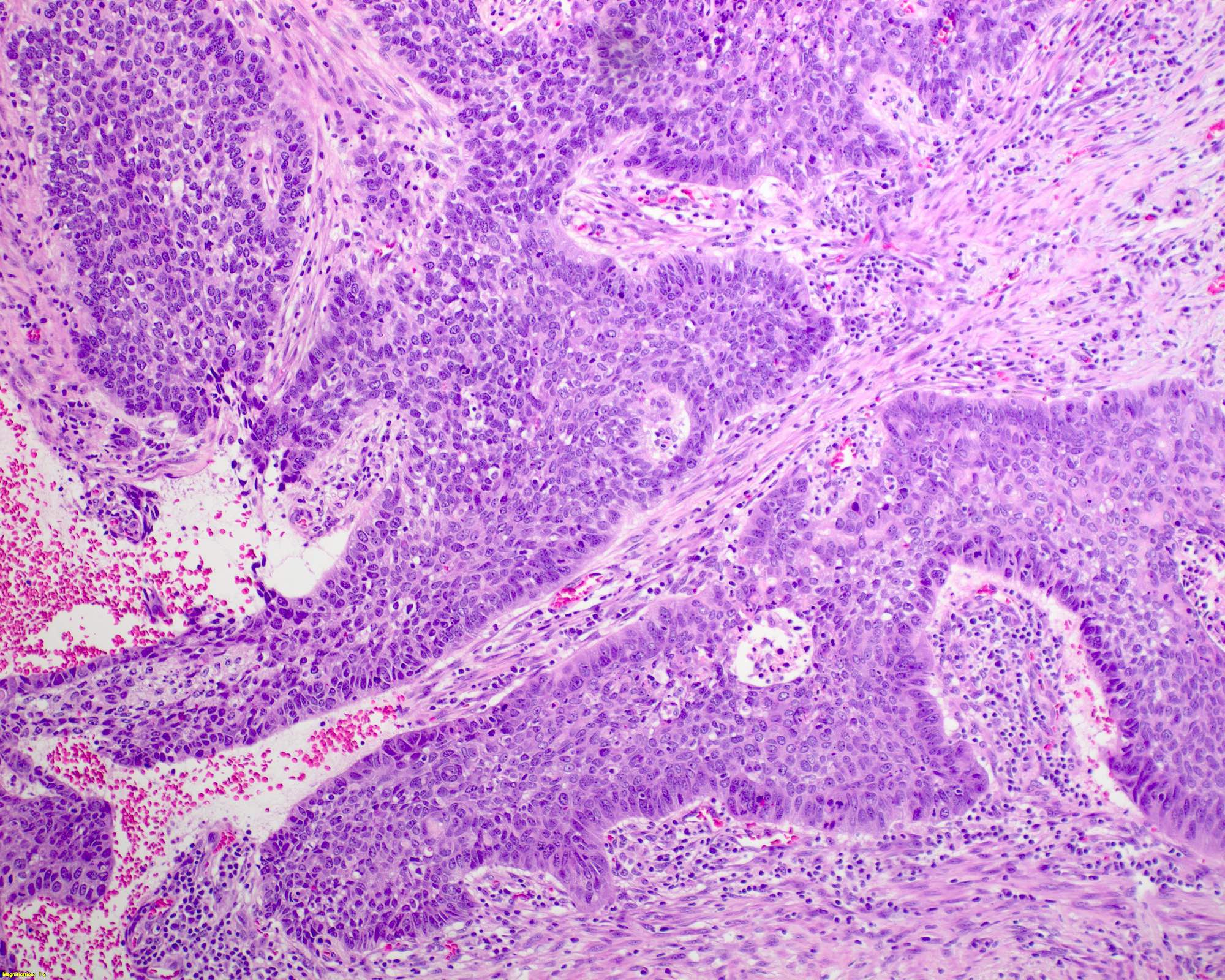 Palisading nuclei in basaloid type
