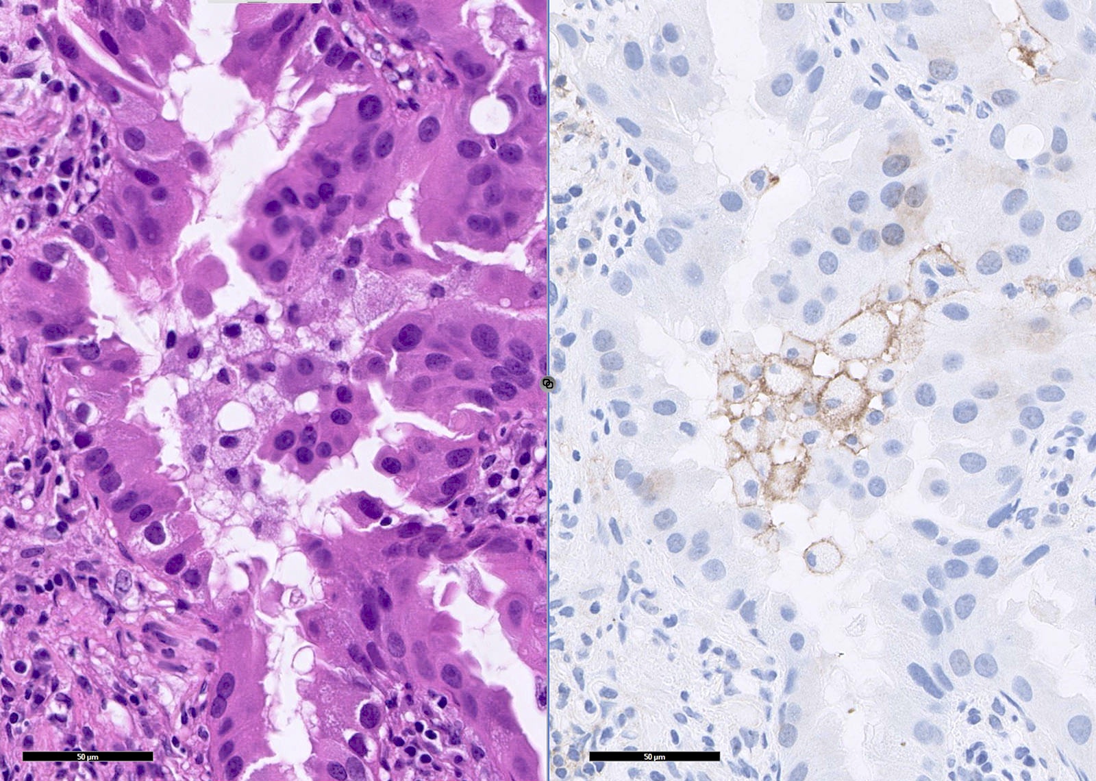 Negative PDL1