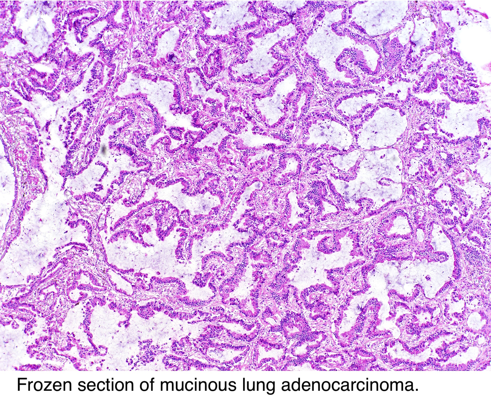 malignant pleural mesothelioma and immunotherapy