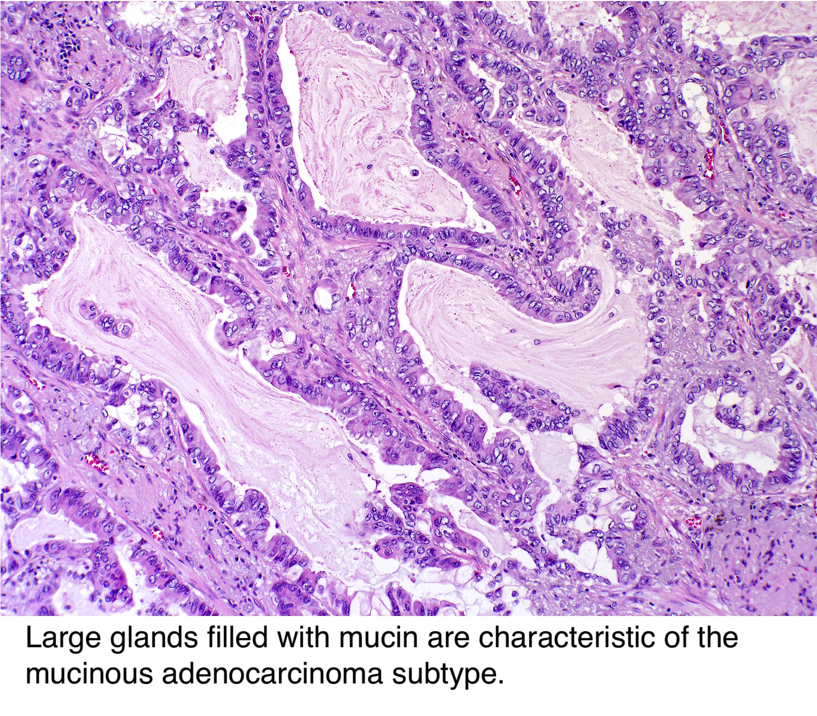 mucinous adenocarcinoma prostate pathology outlines