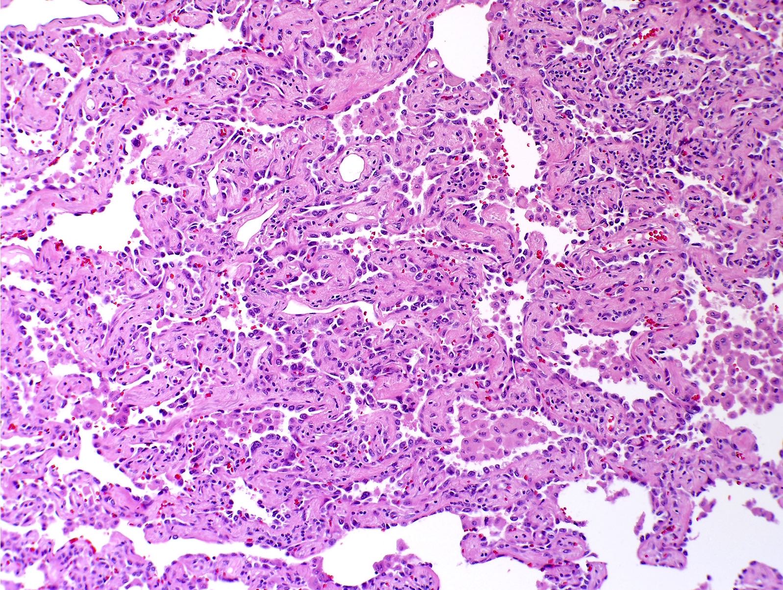 Lung Carcinoma Histology