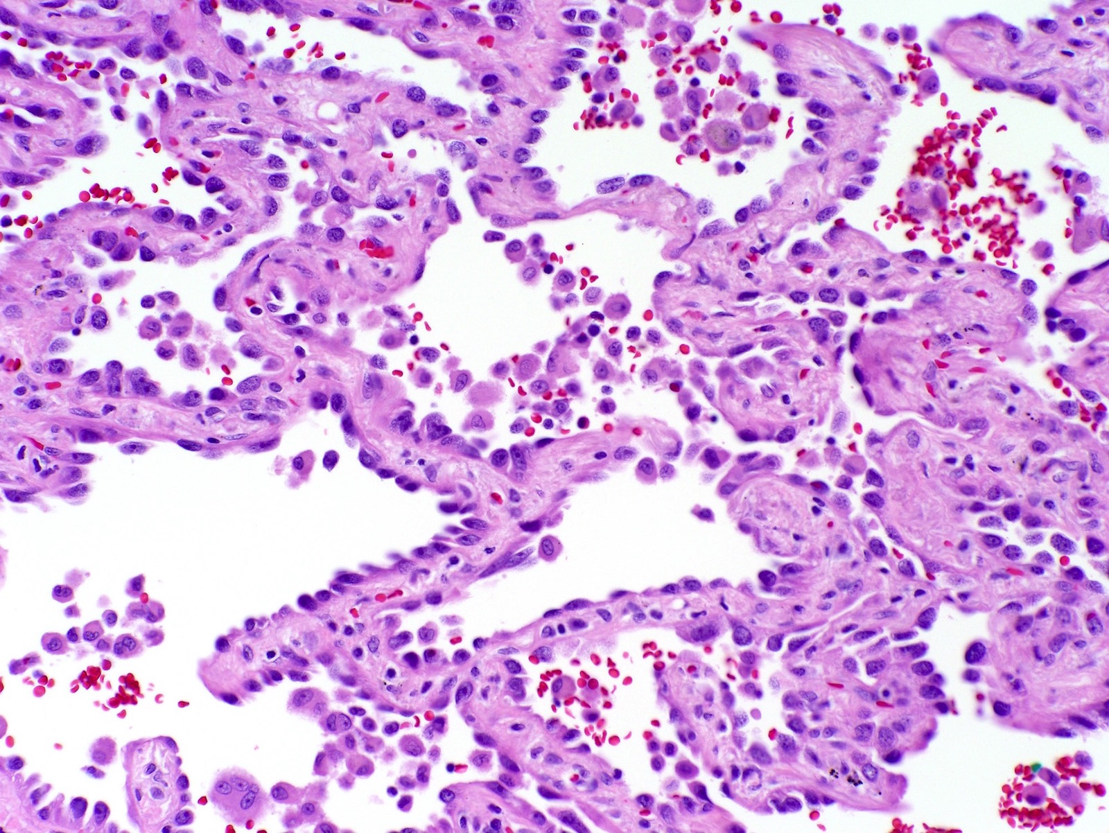 Lepidic pattern, cytologic features