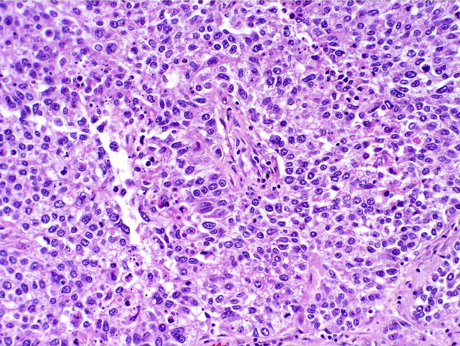 Solid pattern, cytologic features