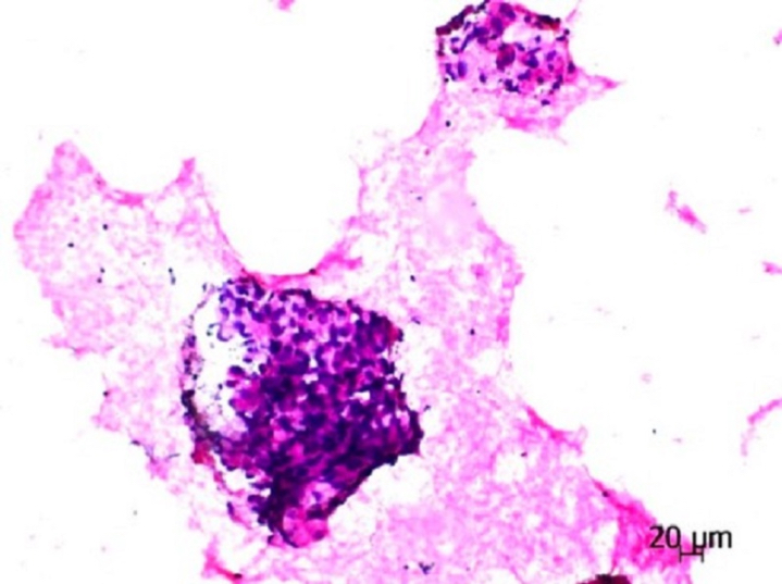 Cluster of tumor cells