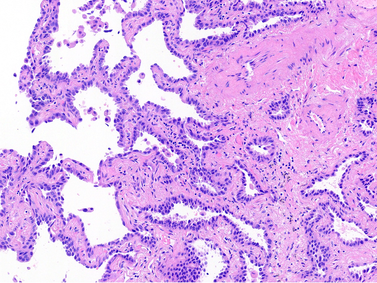 High power of lepidic adenocarcinoma with focal invasion