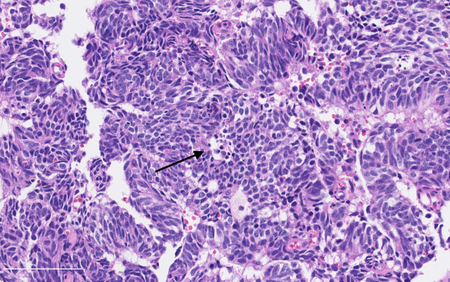 Atypical carcinoid