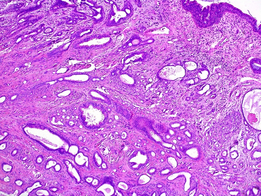 Epithelial myoepithelial carcinoma arising from airway
