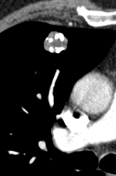 Hamartoma with calcifications