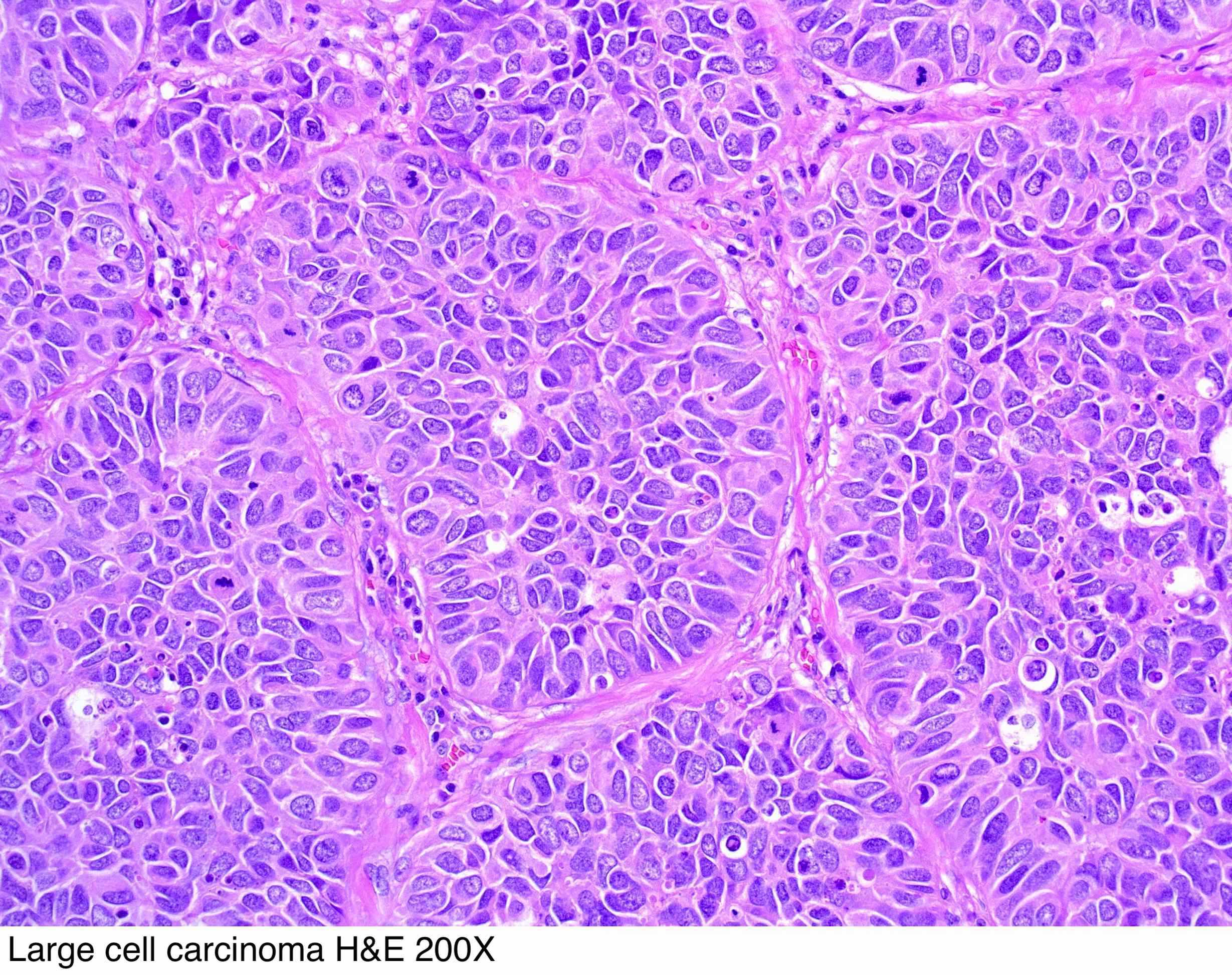 adenocarcinoma with neuroendocrine differentiation pathology outlines