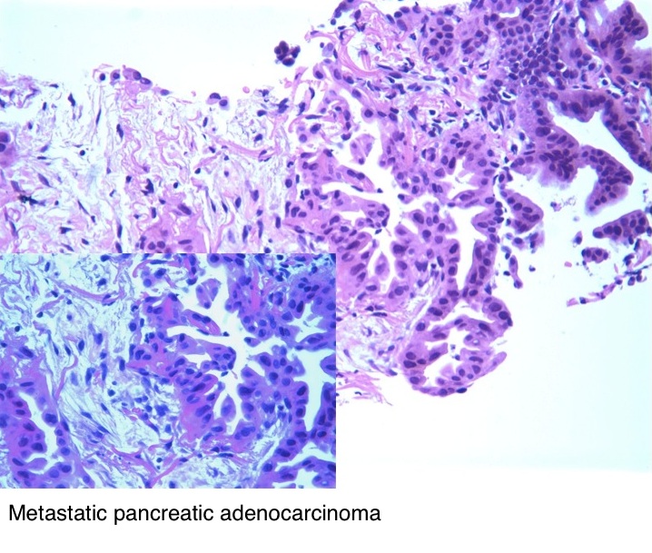 Pancreas: adenocarcinoma