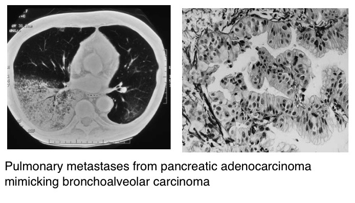 Pancreas: adenocarcinoma