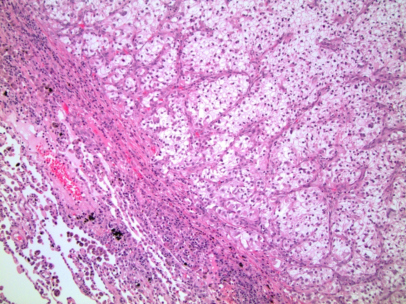 Clear cell renal<br>cell carcinoma<br>metastatic to lung