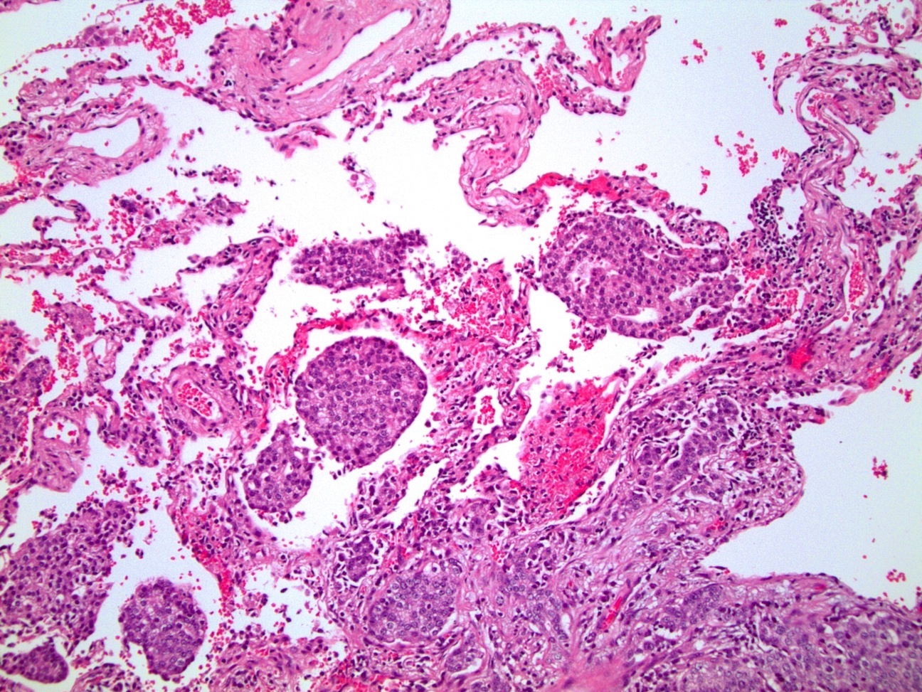 Prostatic<br>adenocarcinoma<br>metastatic to lung