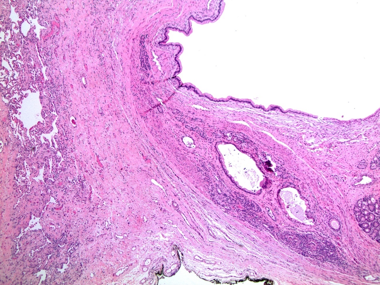 Testicular germ<br>cell tumor (teratoma)<br>metastatic to lung