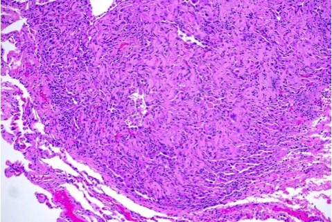 Micronodular pneumocyte hyperplasia