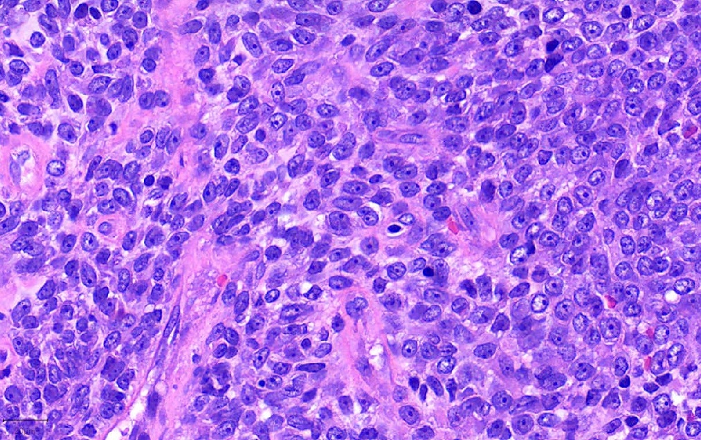 Pathology Outlines NUT carcinoma