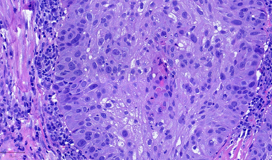 Pathology Outlines NUT carcinoma