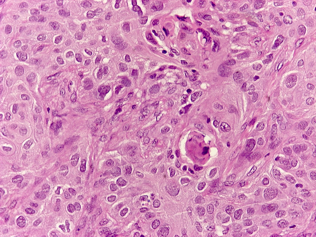 Pathology Outlines NUT carcinoma