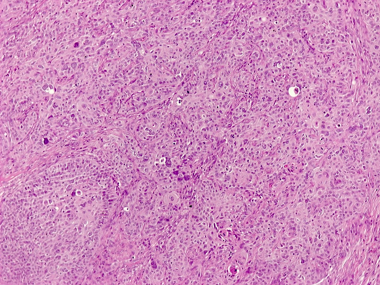 Pathology Outlines NUT carcinoma