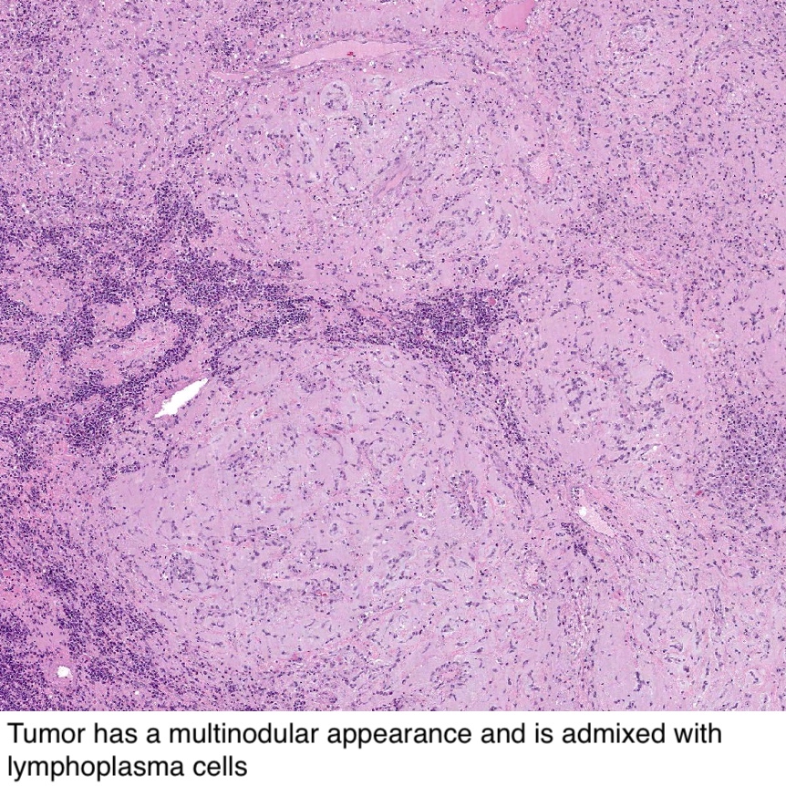 cancer sarcoma myxoid